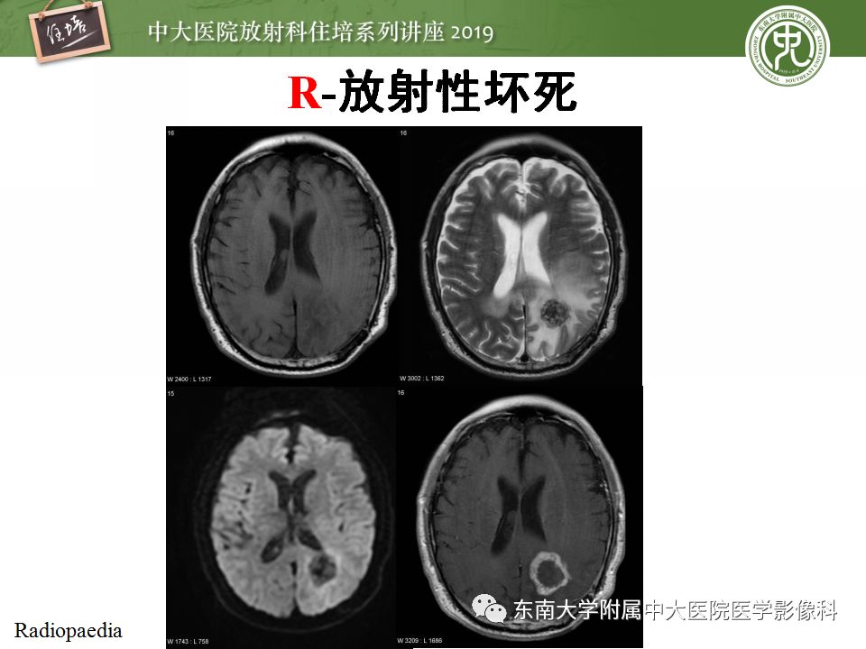 【PPT】脑脓肿的诊断与鉴别