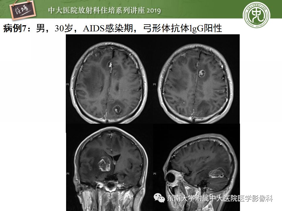 【PPT】脑脓肿的诊断与鉴别