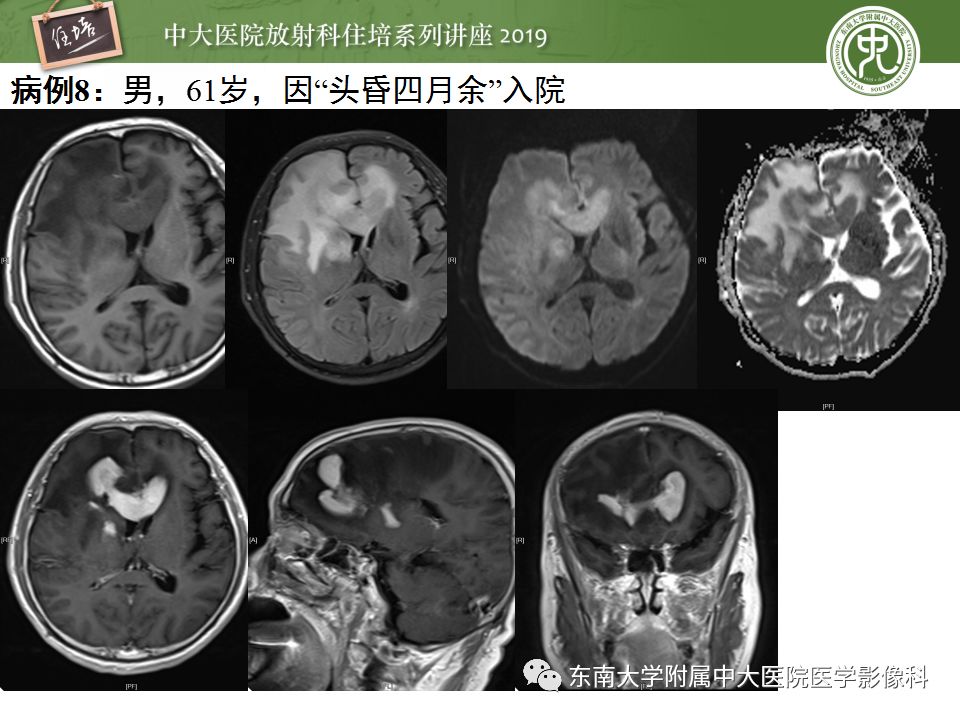 【PPT】脑脓肿的诊断与鉴别