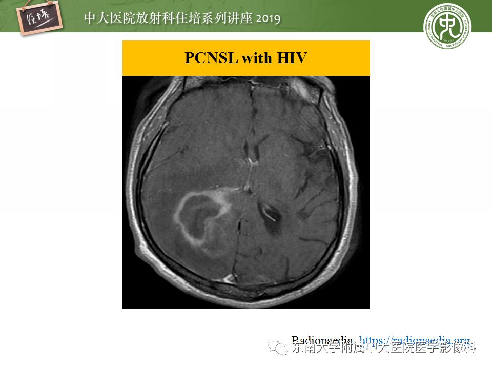 【PPT】脑脓肿的诊断与鉴别