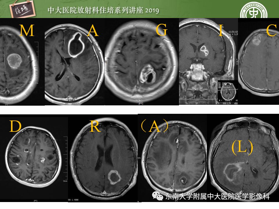【PPT】脑脓肿的诊断与鉴别