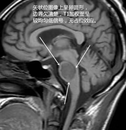脱髓鞘病变特征及示例 脱髓鞘病变特征及示例