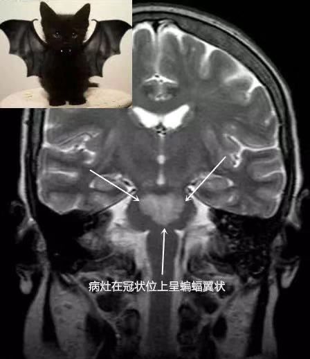 脱髓鞘病变特征及示例 脱髓鞘病变特征及示例