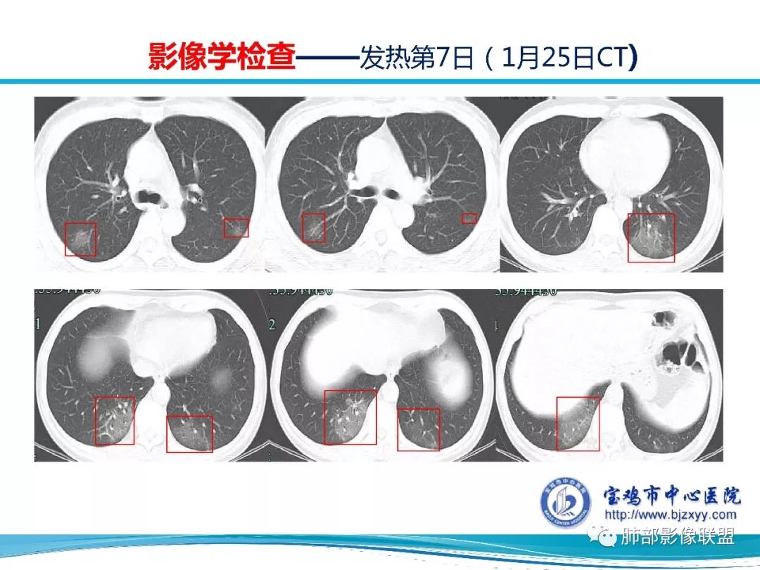 【PPT】宝鸡地区2019-nCoV肺炎确诊病例分享 【PPT】宝鸡地区2019-nCoV肺炎确诊病例分享