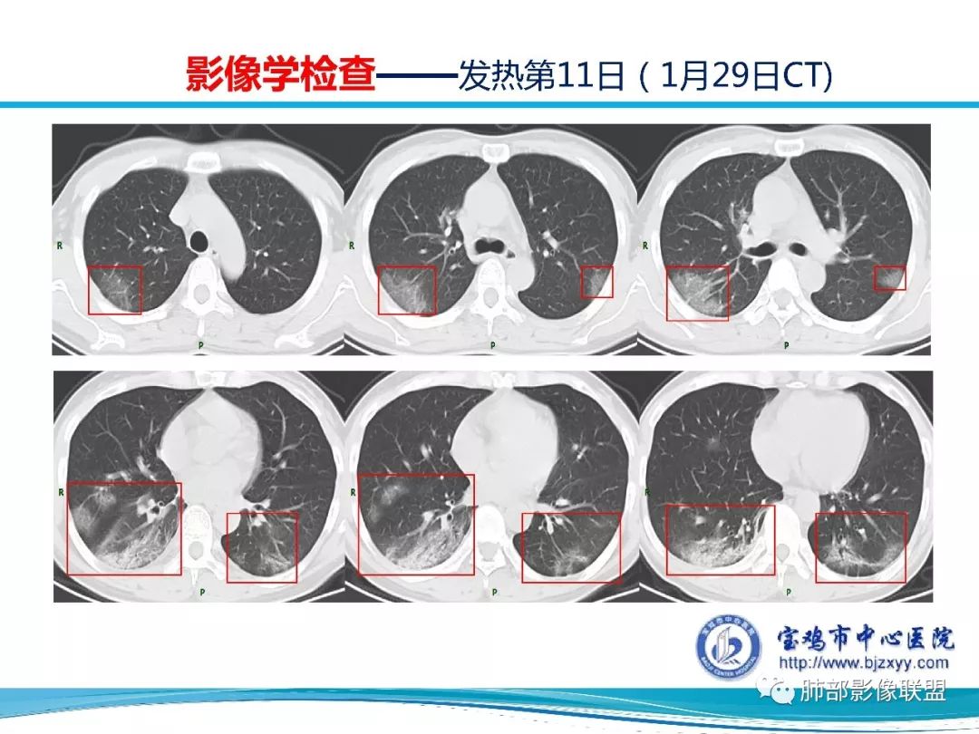 【PPT】宝鸡地区2019-nCoV肺炎确诊病例分享 【PPT】宝鸡地区2019-nCoV肺炎确诊病例分享