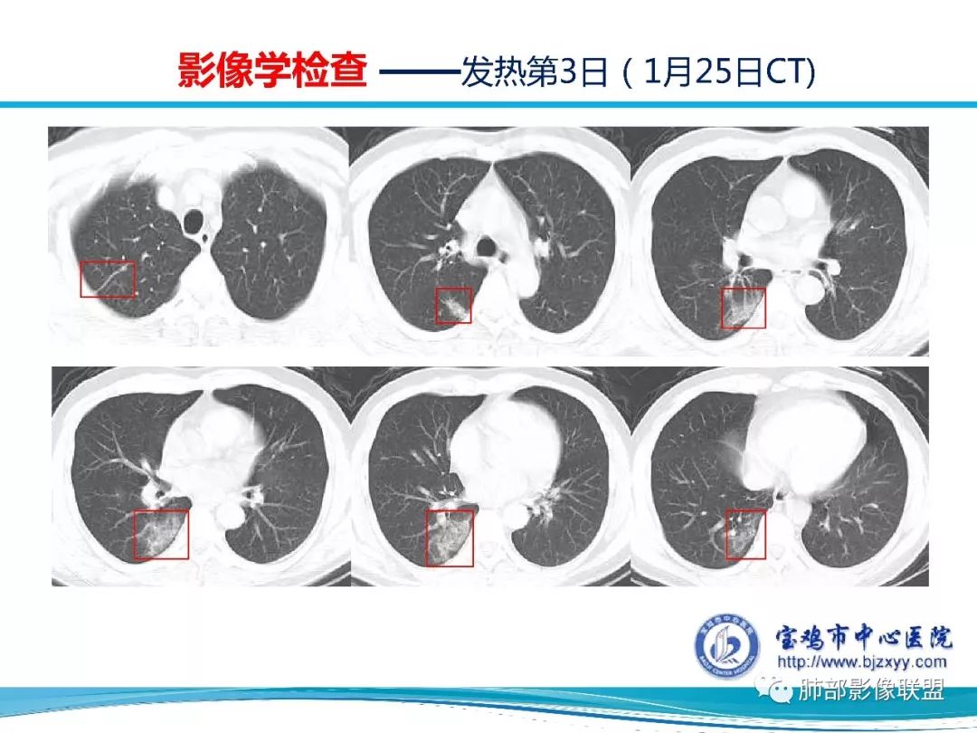 【PPT】宝鸡地区2019-nCoV肺炎确诊病例分享 【PPT】宝鸡地区2019-nCoV肺炎确诊病例分享