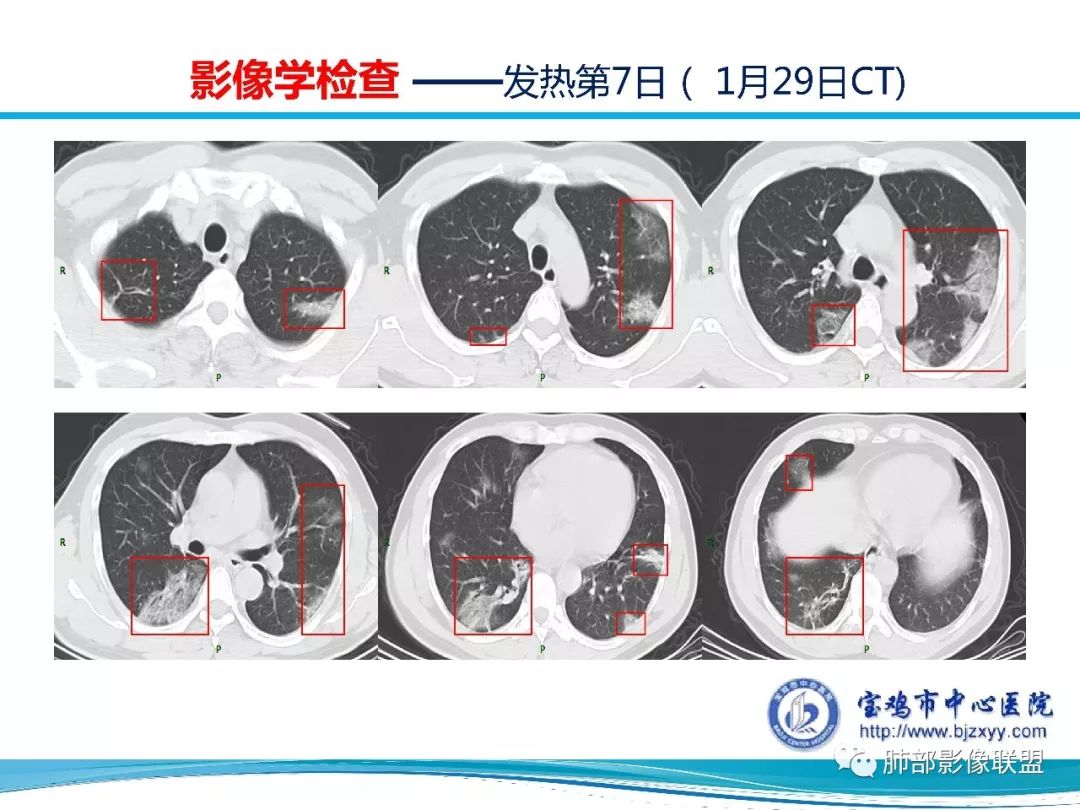 【PPT】宝鸡地区2019-nCoV肺炎确诊病例分享 【PPT】宝鸡地区2019-nCoV肺炎确诊病例分享