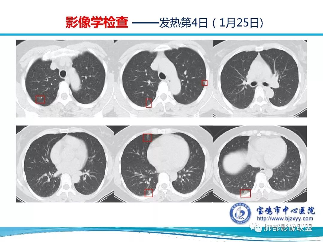 【PPT】宝鸡地区2019-nCoV肺炎确诊病例分享 【PPT】宝鸡地区2019-nCoV肺炎确诊病例分享