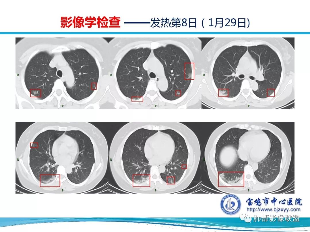 【PPT】宝鸡地区2019-nCoV肺炎确诊病例分享 【PPT】宝鸡地区2019-nCoV肺炎确诊病例分享