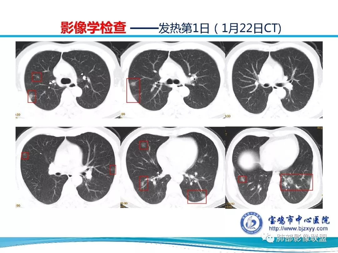 【PPT】宝鸡地区2019-nCoV肺炎确诊病例分享 【PPT】宝鸡地区2019-nCoV肺炎确诊病例分享