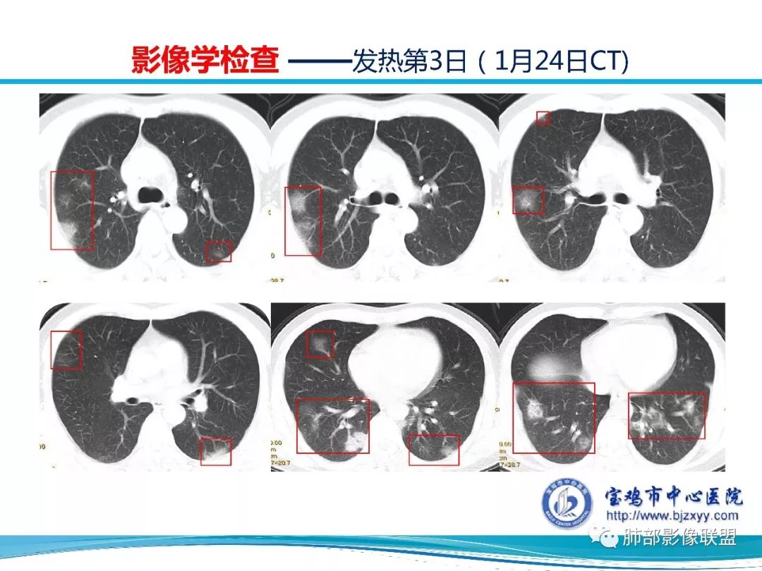 【PPT】宝鸡地区2019-nCoV肺炎确诊病例分享 【PPT】宝鸡地区2019-nCoV肺炎确诊病例分享