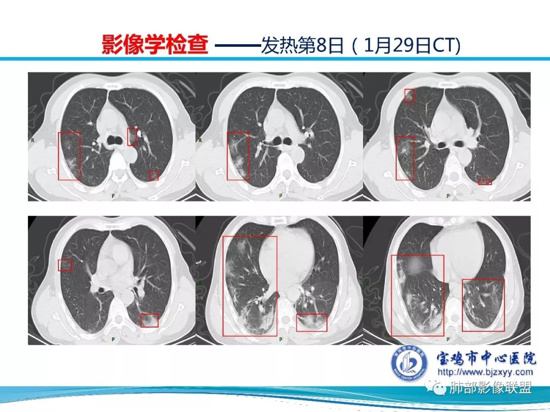 【PPT】宝鸡地区2019-nCoV肺炎确诊病例分享 【PPT】宝鸡地区2019-nCoV肺炎确诊病例分享