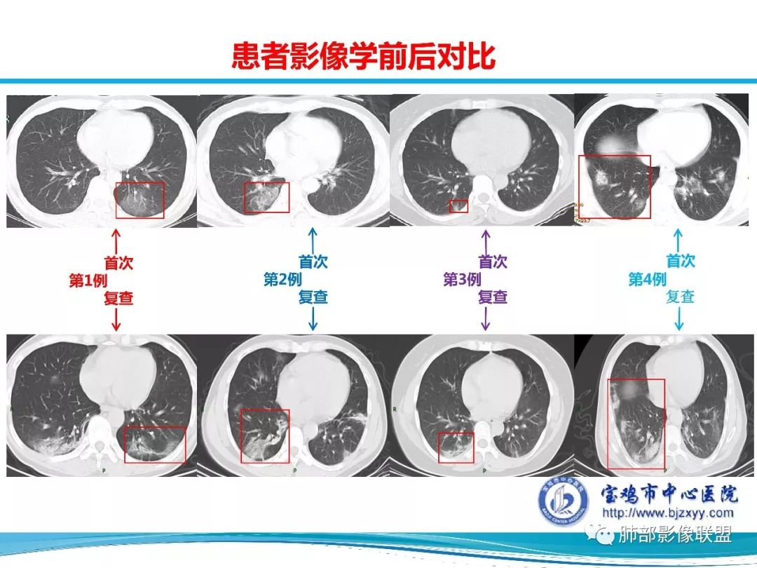 【PPT】宝鸡地区2019-nCoV肺炎确诊病例分享 【PPT】宝鸡地区2019-nCoV肺炎确诊病例分享