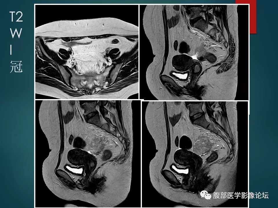 【病例】盆腔孤立性纤维性肿瘤1例MR