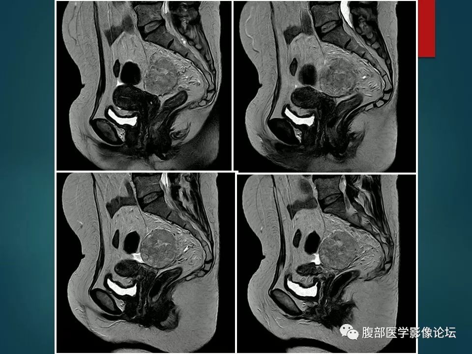 【病例】盆腔孤立性纤维性肿瘤1例MR