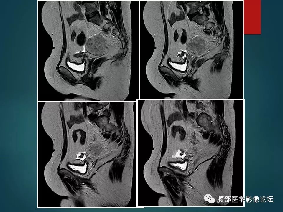 【病例】盆腔孤立性纤维性肿瘤1例MR