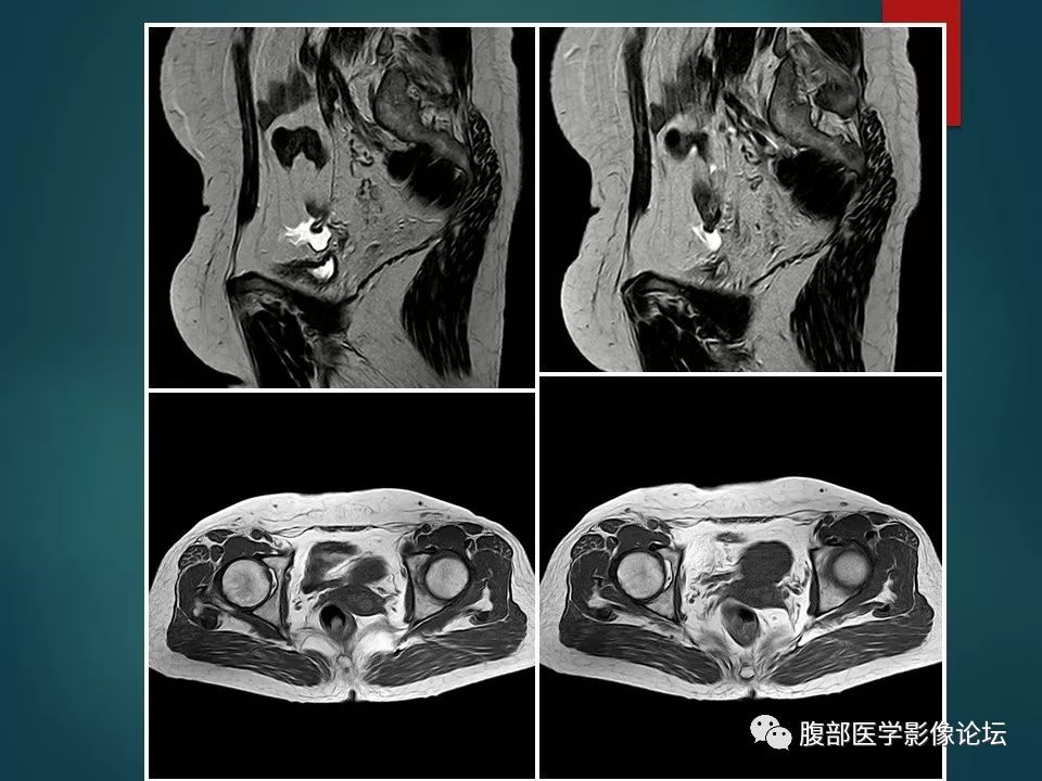【病例】盆腔孤立性纤维性肿瘤1例MR