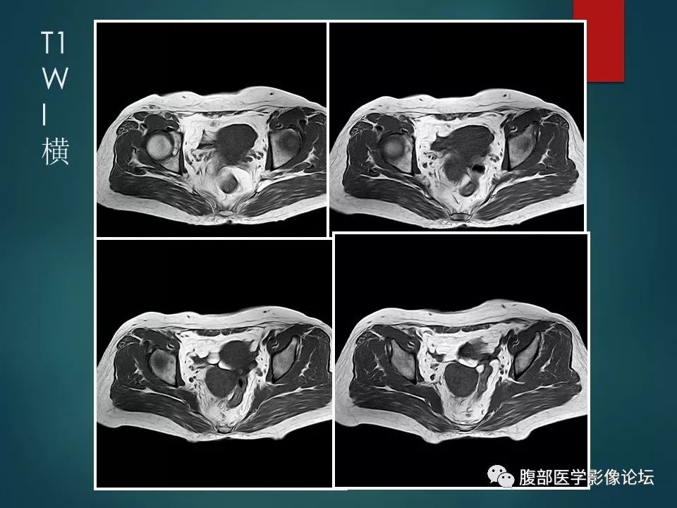 【病例】盆腔孤立性纤维性肿瘤1例MR