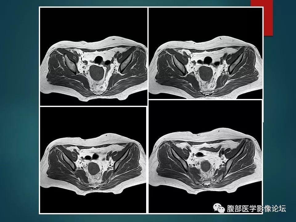 【病例】盆腔孤立性纤维性肿瘤1例MR