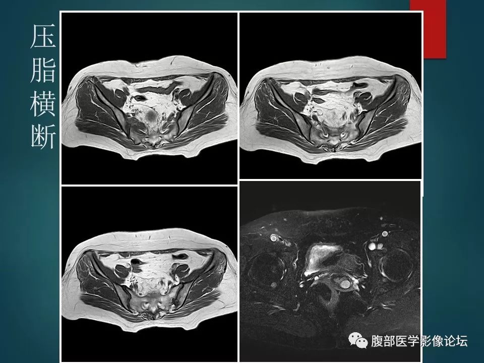 【病例】盆腔孤立性纤维性肿瘤1例MR