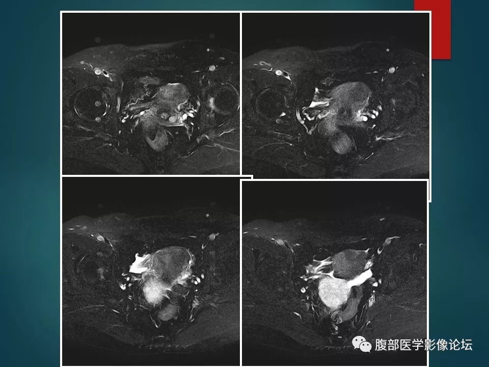 【病例】盆腔孤立性纤维性肿瘤1例MR