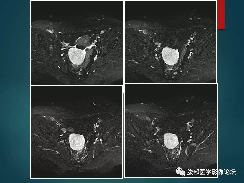 【病例】盆腔孤立性纤维性肿瘤1例MR