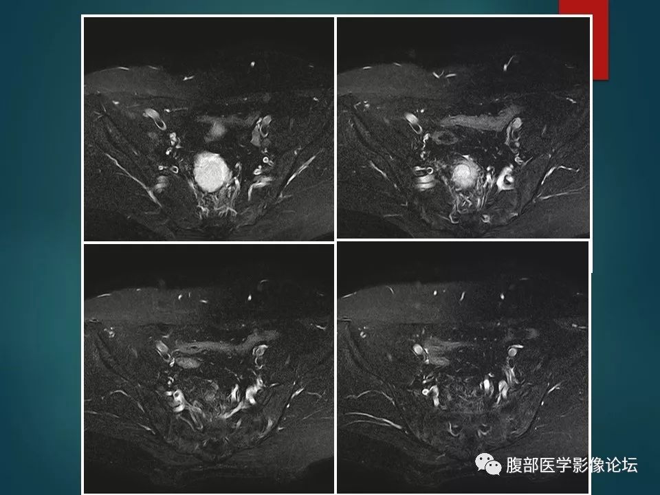 【病例】盆腔孤立性纤维性肿瘤1例MR