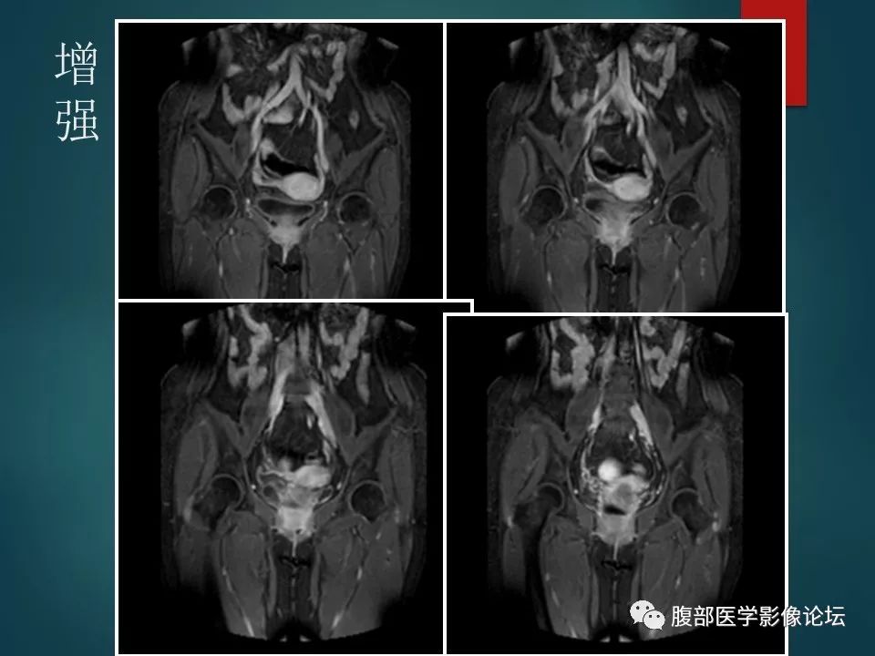 【病例】盆腔孤立性纤维性肿瘤1例MR