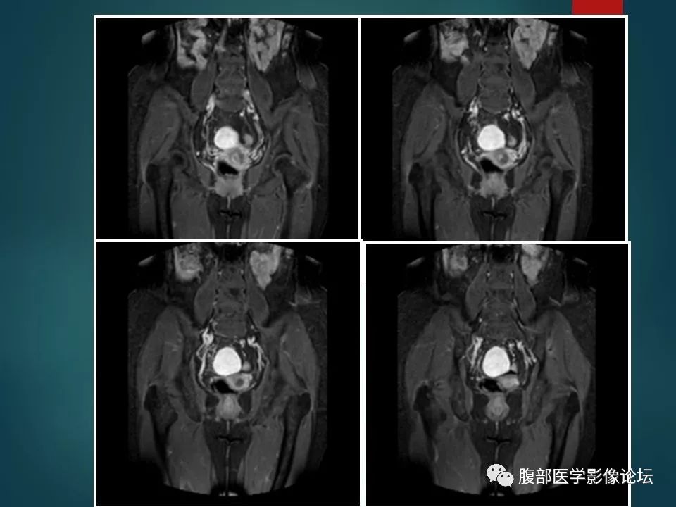 【病例】盆腔孤立性纤维性肿瘤1例MR