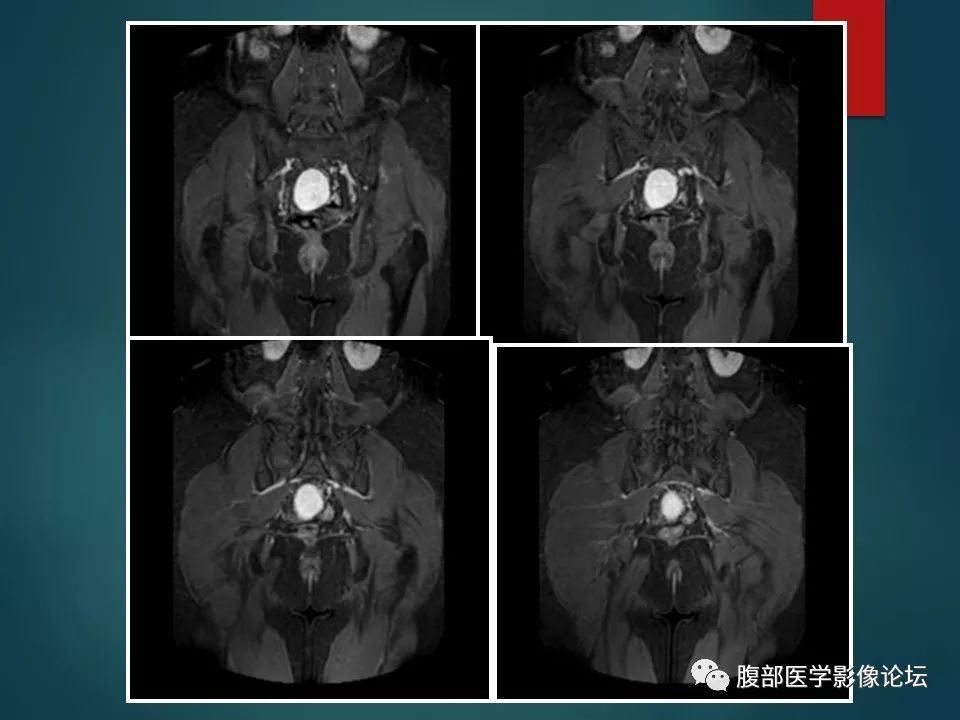 【病例】盆腔孤立性纤维性肿瘤1例MR