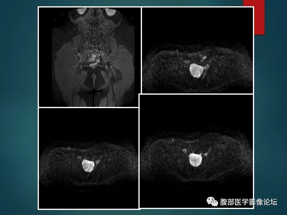 【病例】盆腔孤立性纤维性肿瘤1例MR