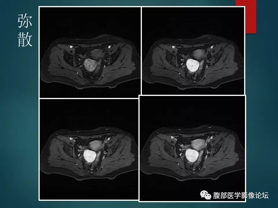 【病例】盆腔孤立性纤维性肿瘤1例MR