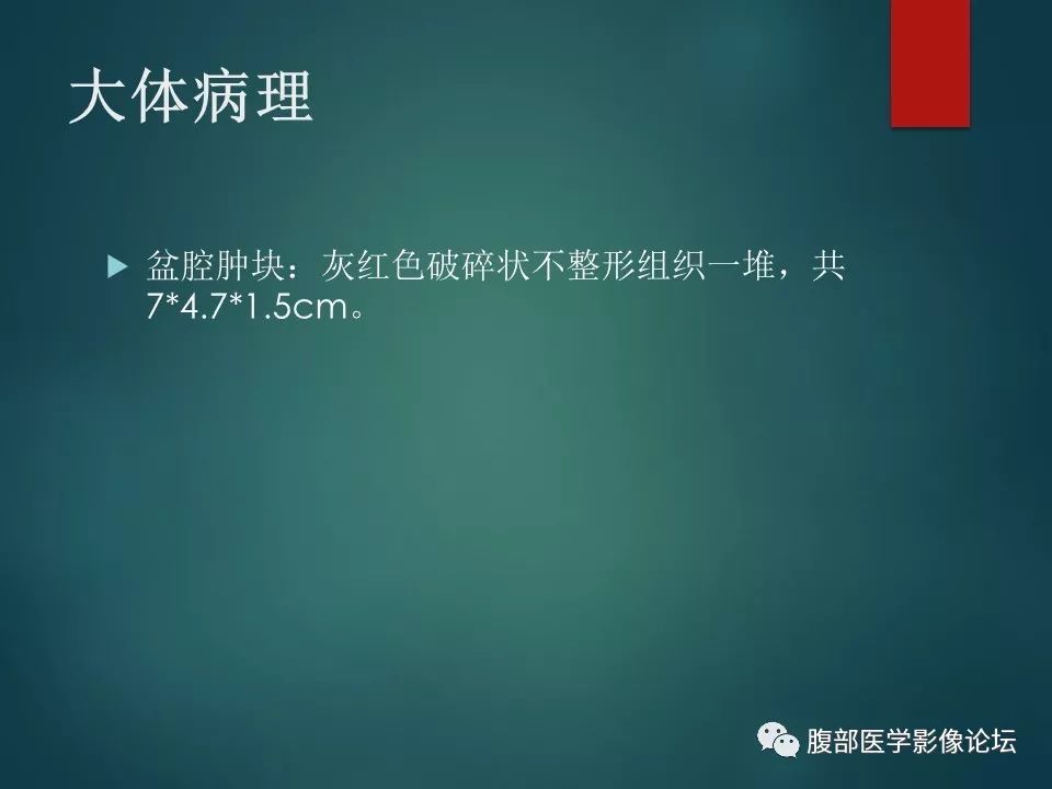 【病例】盆腔孤立性纤维性肿瘤1例MR