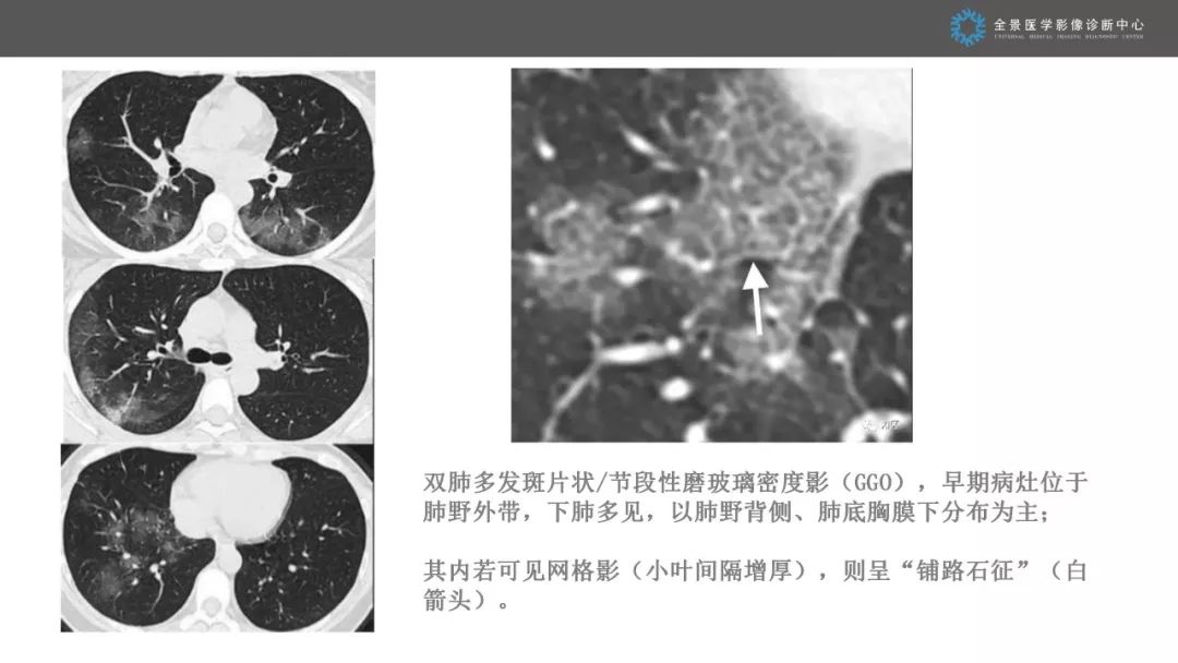 【PPT】优化HRCT报告对于疑似新型冠状病毒性肺炎诊断的意义