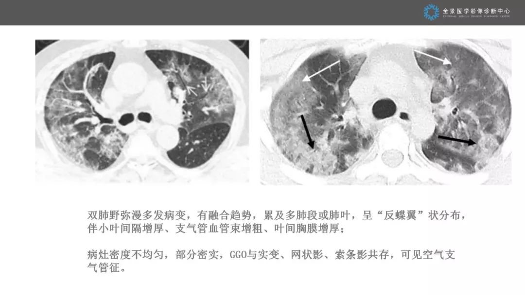 【PPT】优化HRCT报告对于疑似新型冠状病毒性肺炎诊断的意义