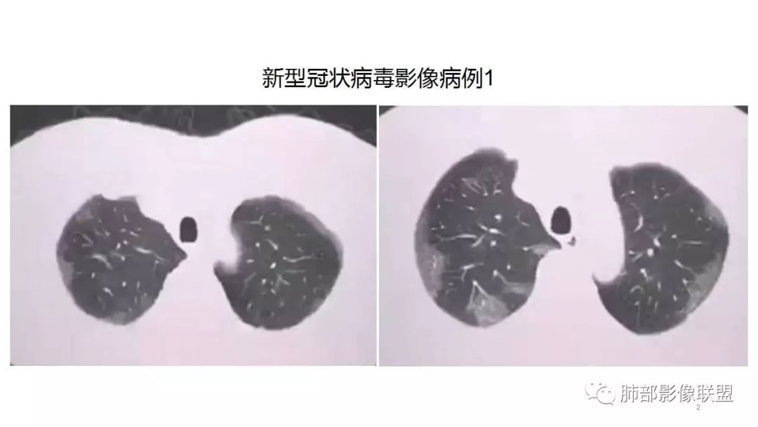 【PPT】病毒性肺炎影像诊断