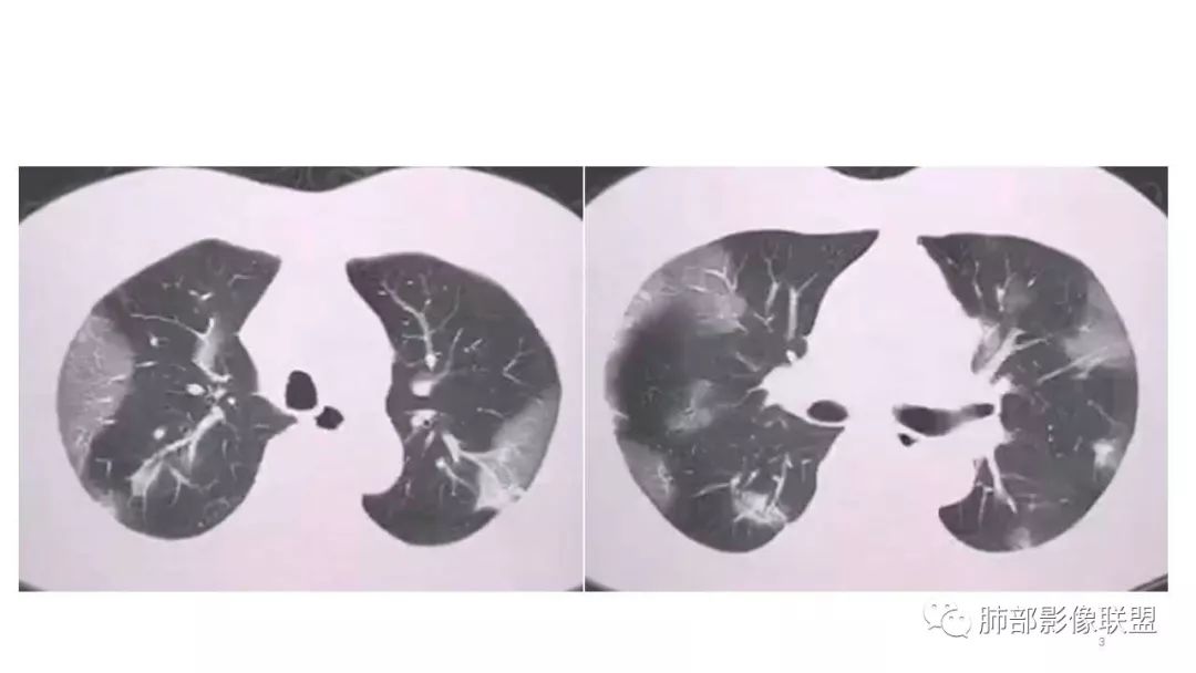 【PPT】病毒性肺炎影像诊断