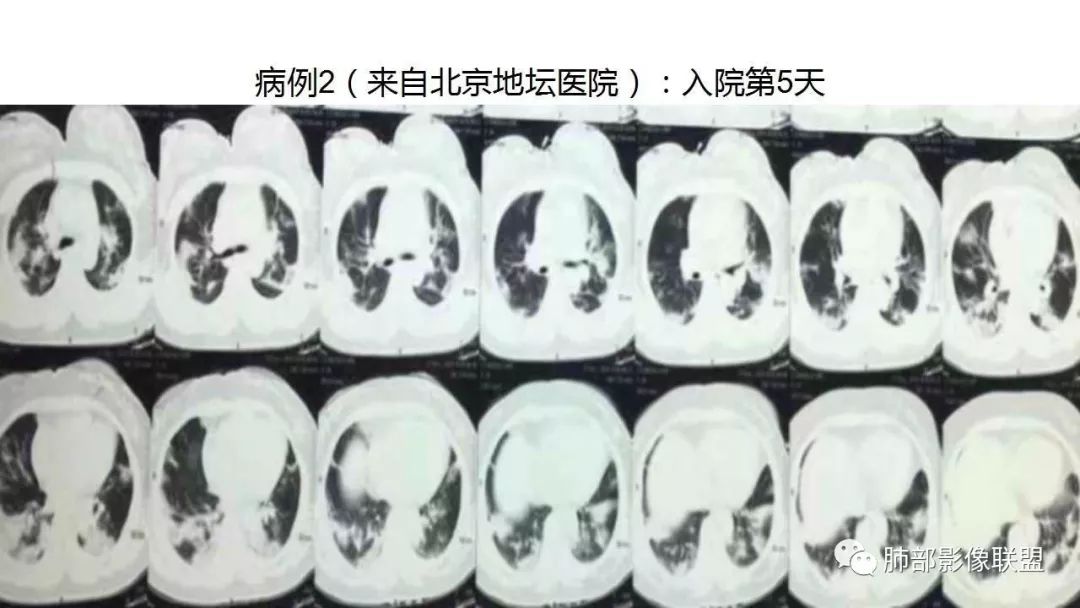 【PPT】病毒性肺炎影像诊断