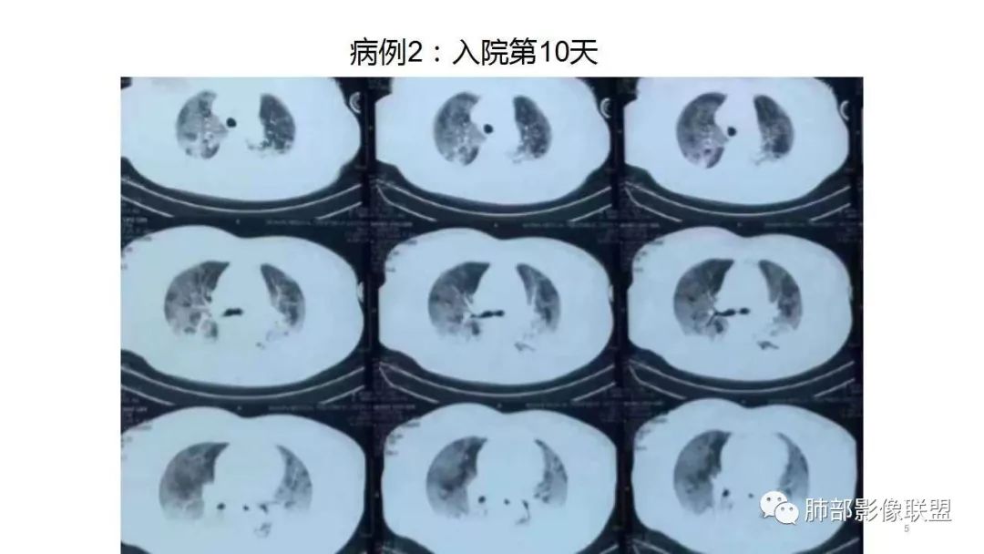 【PPT】病毒性肺炎影像诊断
