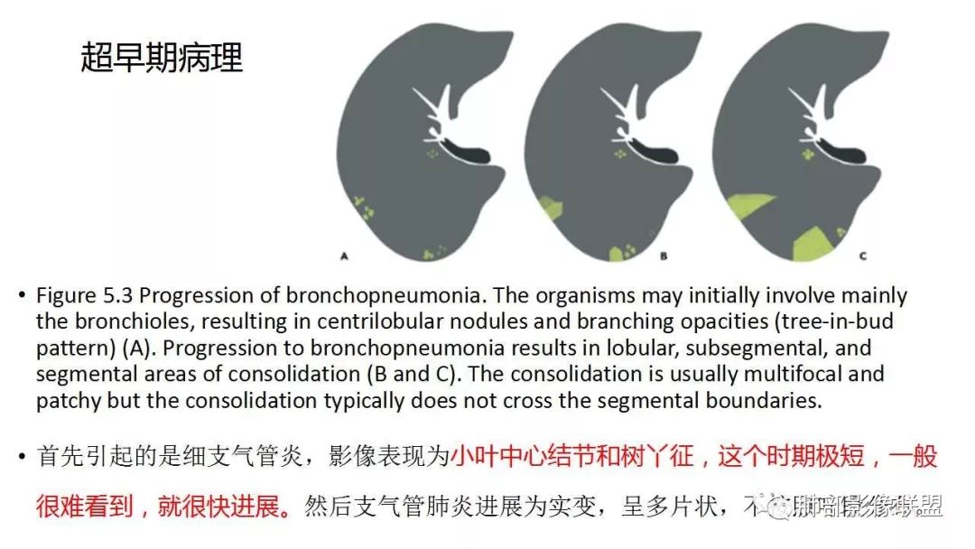 【PPT】病毒性肺炎影像诊断