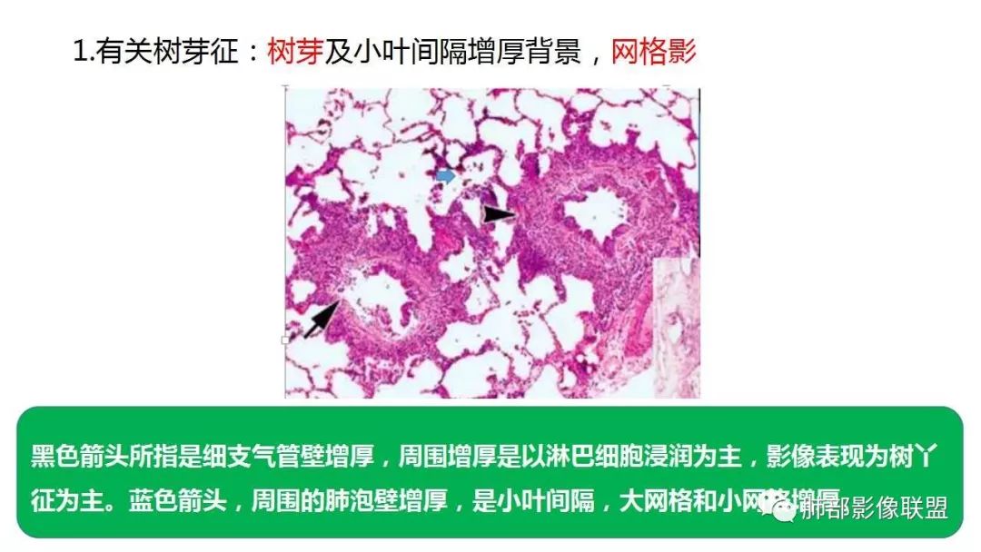 【PPT】病毒性肺炎影像诊断