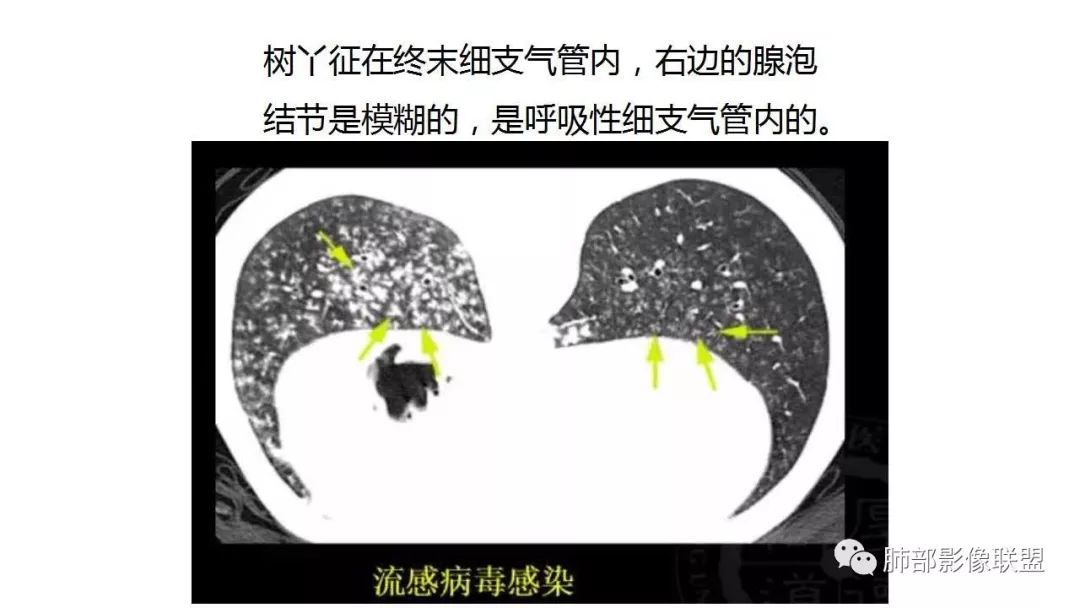 【PPT】病毒性肺炎影像诊断