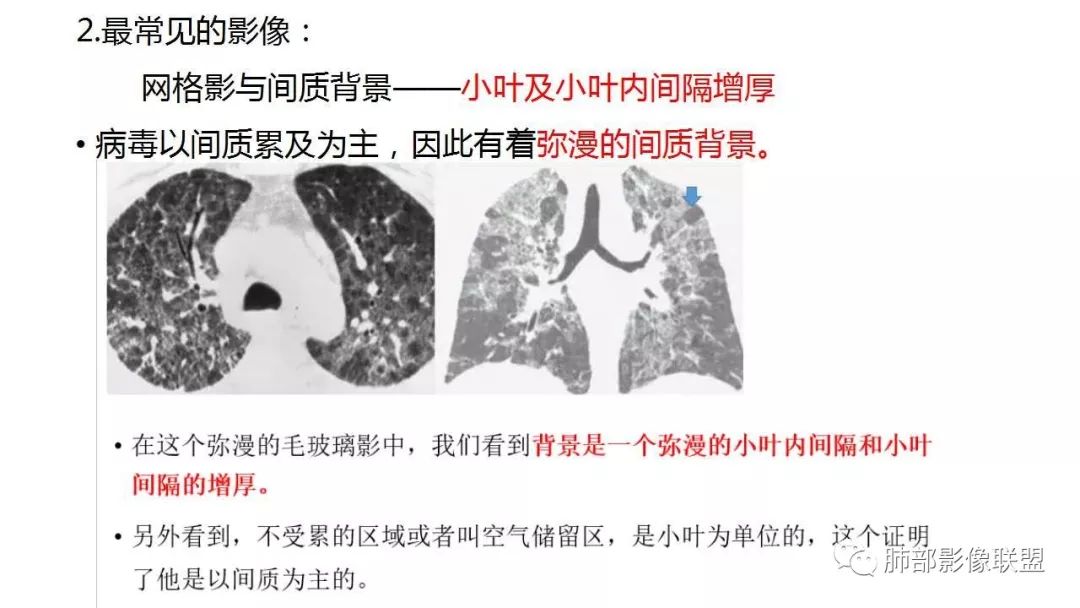 【PPT】病毒性肺炎影像诊断