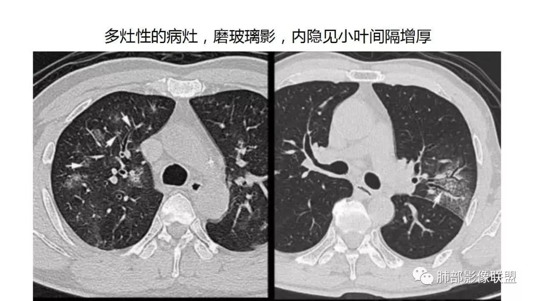 【PPT】病毒性肺炎影像诊断