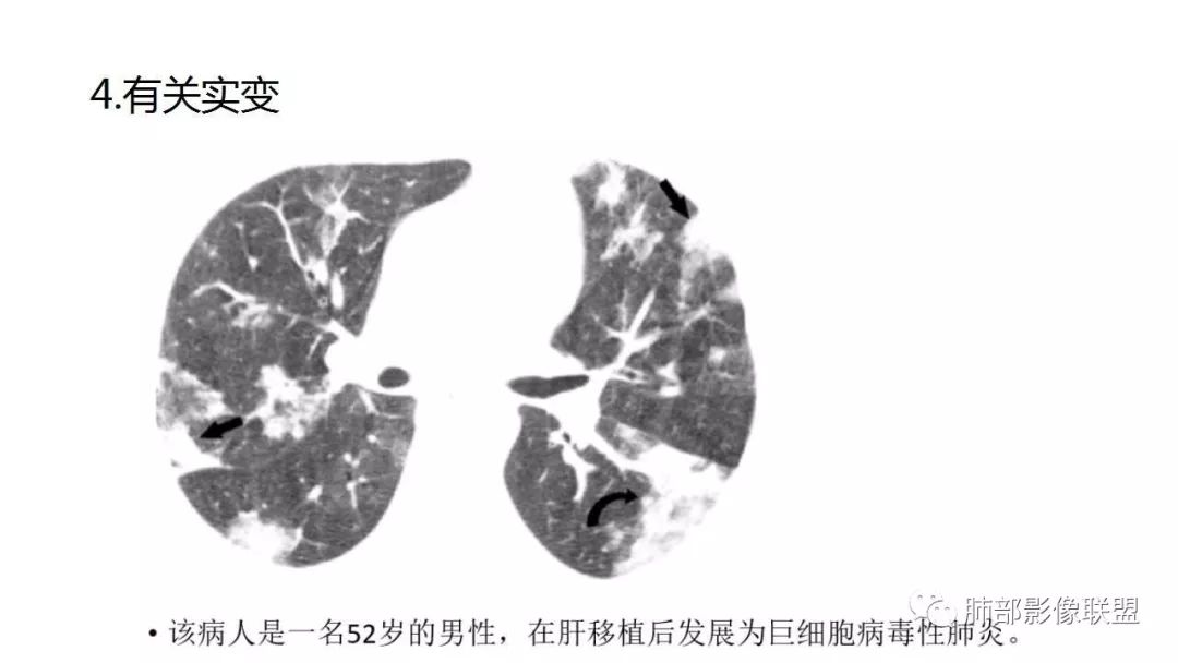【PPT】病毒性肺炎影像诊断