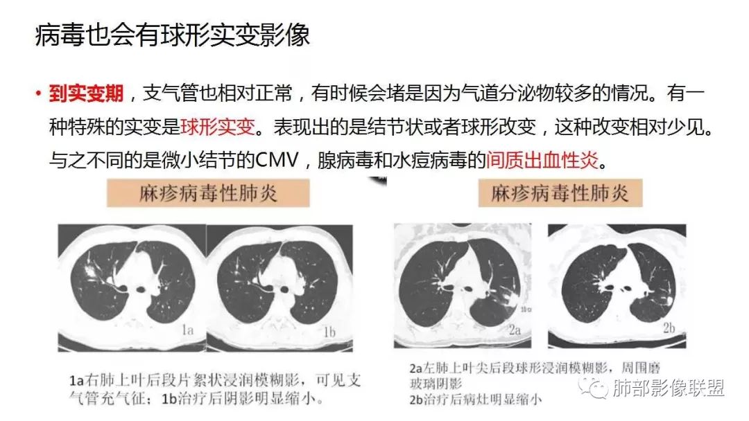 【PPT】病毒性肺炎影像诊断