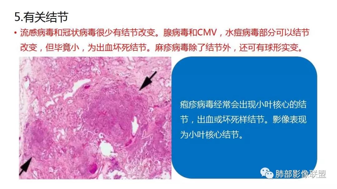 【PPT】病毒性肺炎影像诊断