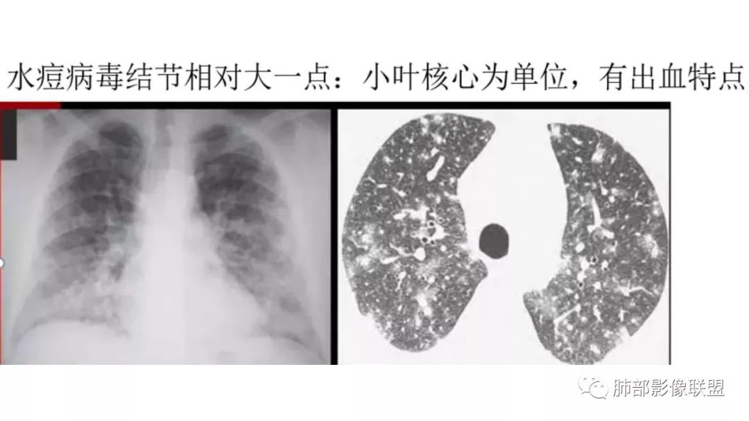【PPT】病毒性肺炎影像诊断