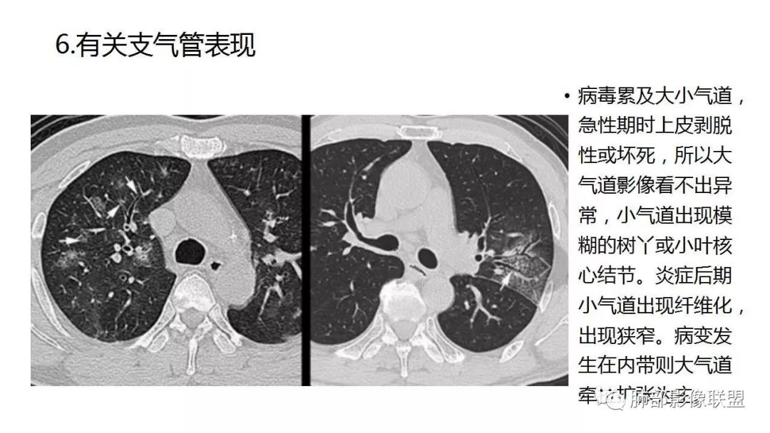 【PPT】病毒性肺炎影像诊断
