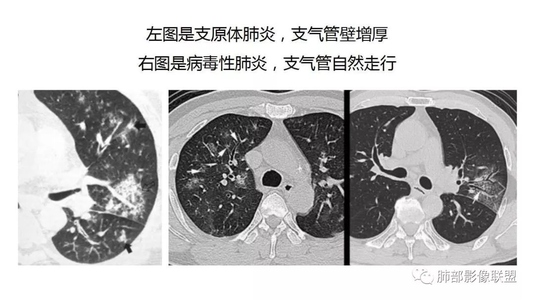 【PPT】病毒性肺炎影像诊断